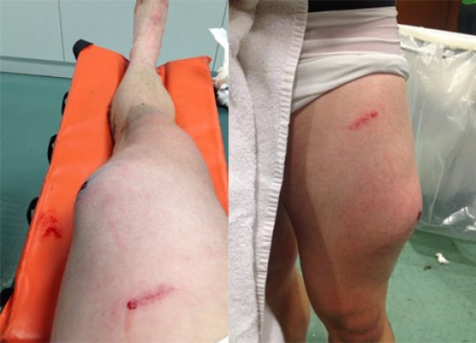 Celtic midfielder Kris Commons certainly knows the expression with glory comes pain as is evident by his leg after last night’s Champions League win against Spartak Moscow.